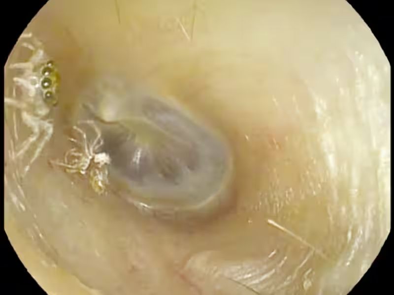 ENT Foreign Body Removal Procedure