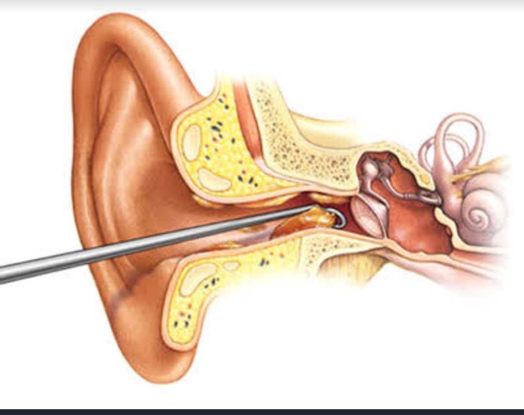 Ear Wax Removal